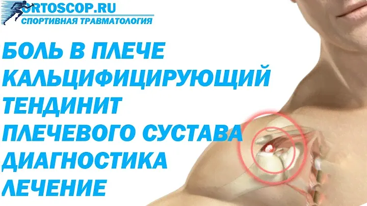 КАЛЬЦИФИЦИРУЮЩИЙ ТЕНДИНИТ ПЛЕЧЕВОГО СУСТАВА
