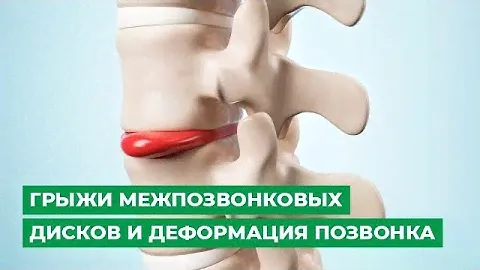 Грыжи межпозвонковых дисков и деформация позвонка